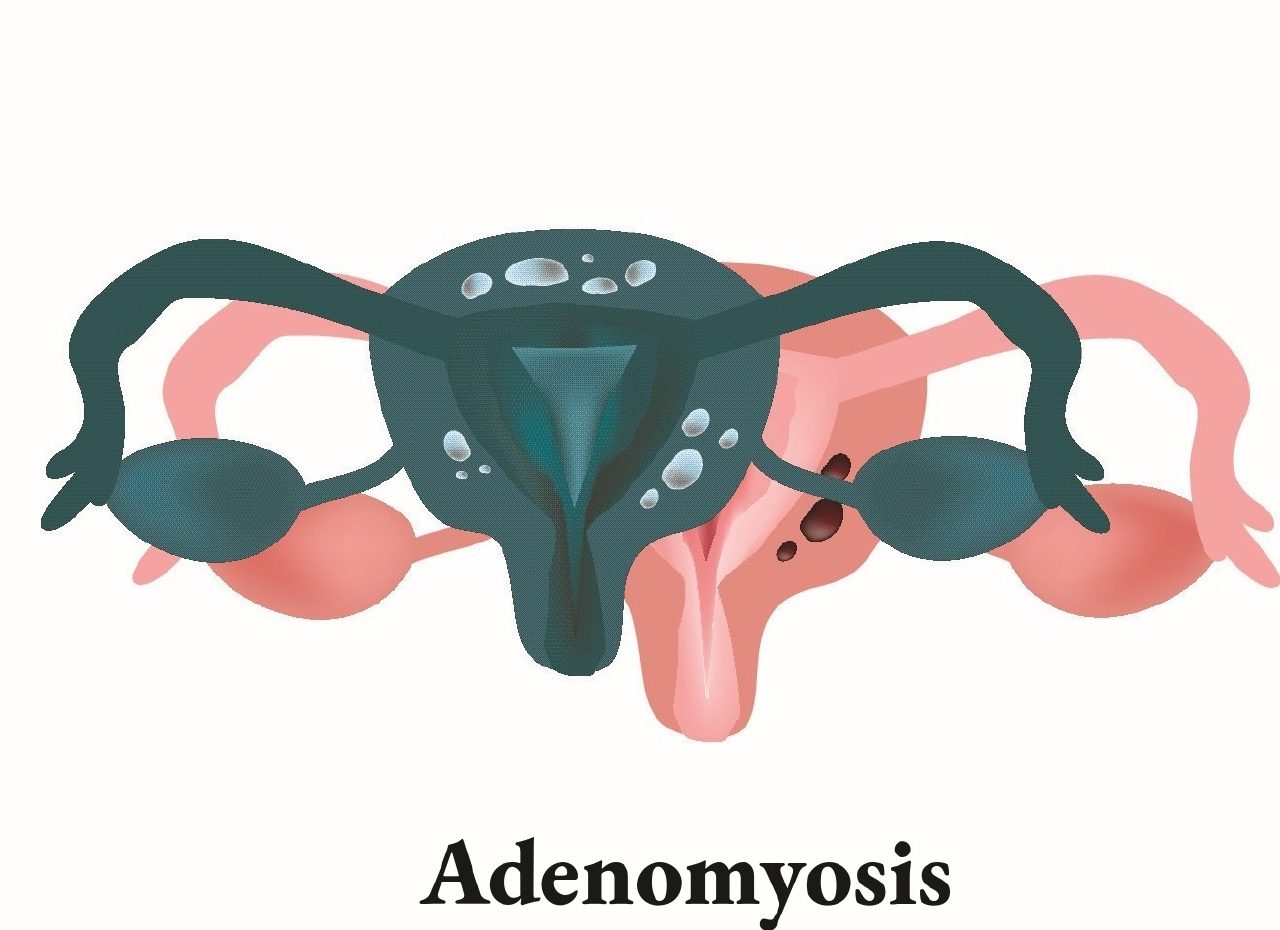 Illustration comparing a uterus affected by adenomyosis with a healthy uterus
