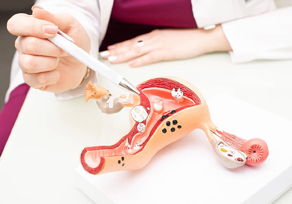 Doctor pointing to uterine fibroids on an anatomical model of the uterus