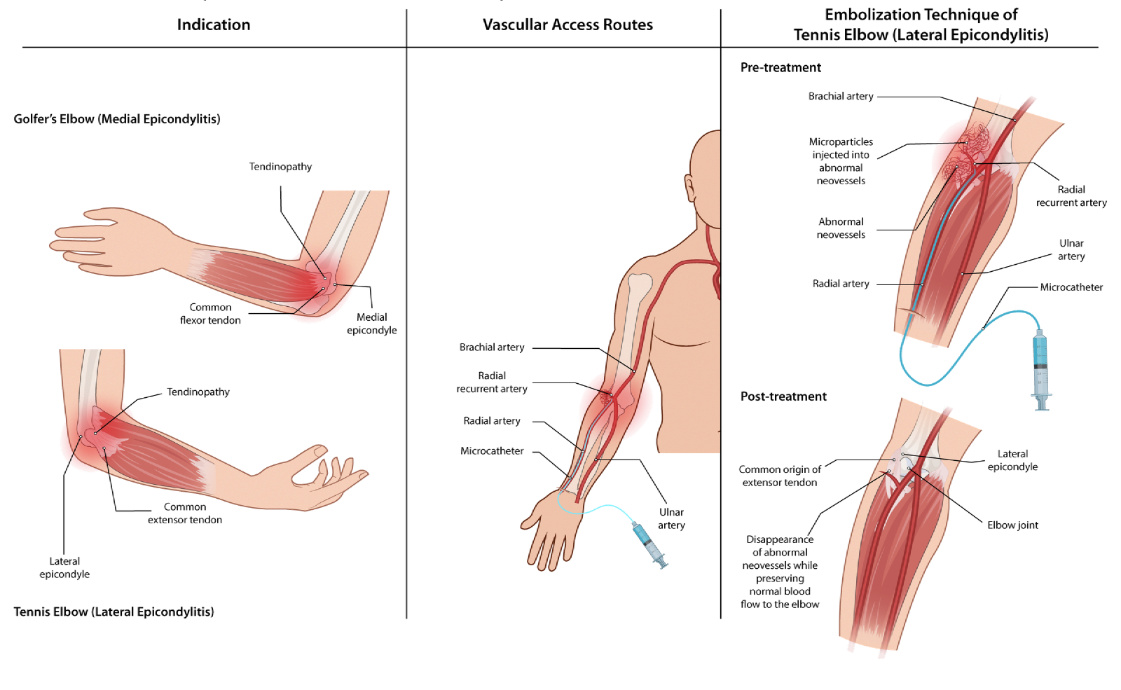 Illustration of elbow embolization for chronic elbow pain
