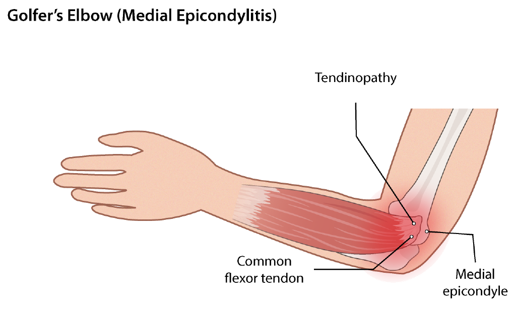 Illustration of golfer's elbow medial epicondylitis