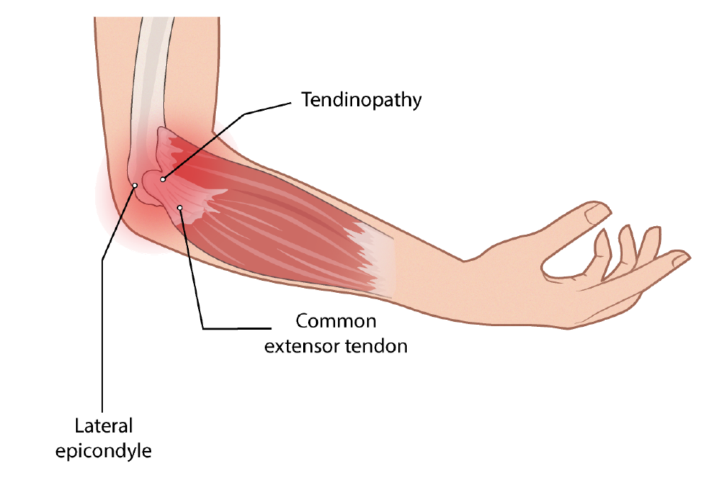 Illustration of tennis elbow lateral epicondylitis
