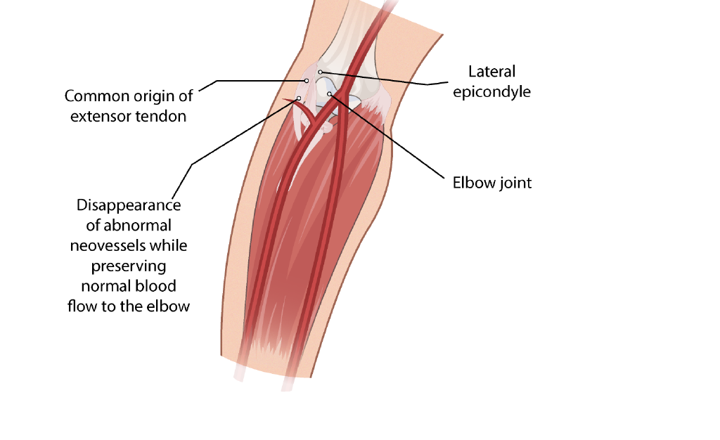 Illustration of post-treatment blood flow after elbow embolization