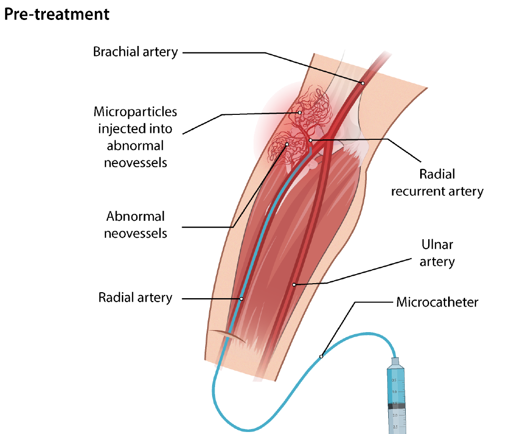 Illustration of tennis elbow embolization technique