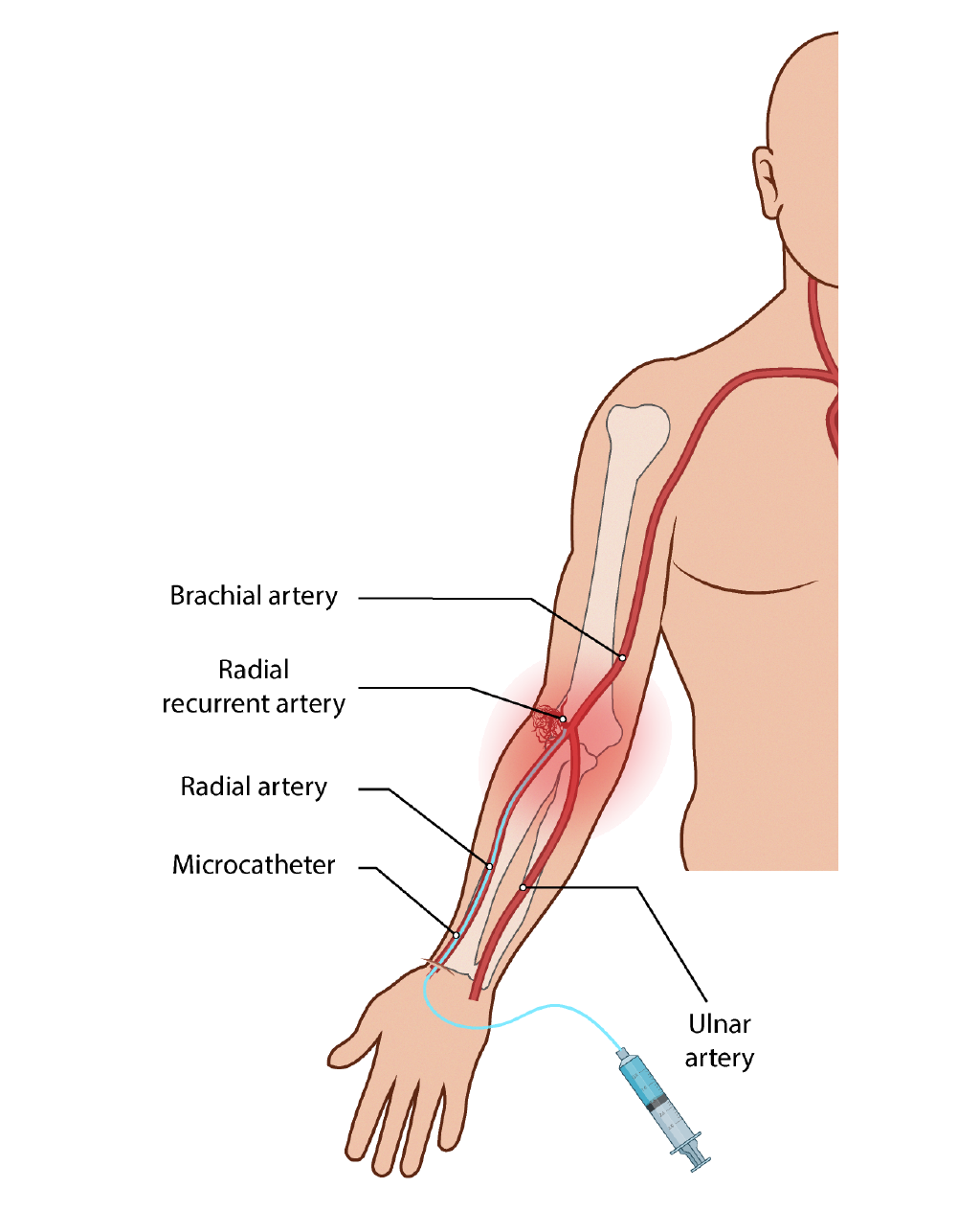 Illustration of vascular access routes for elbow embolization