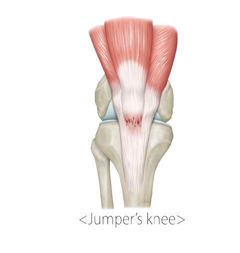 Jumper's knee