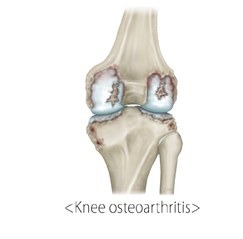Knee osteoarthritis