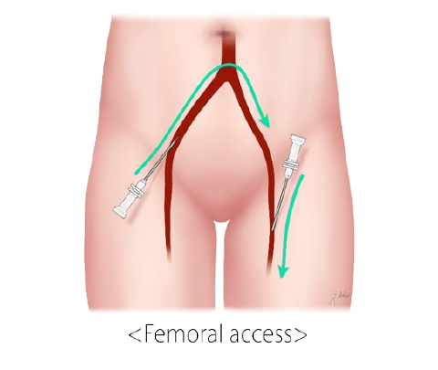 Access through the artery at the top of the thigh