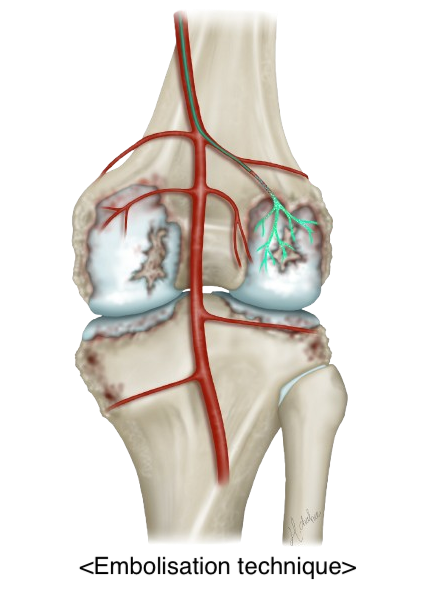 Embolisation of the knee arteries