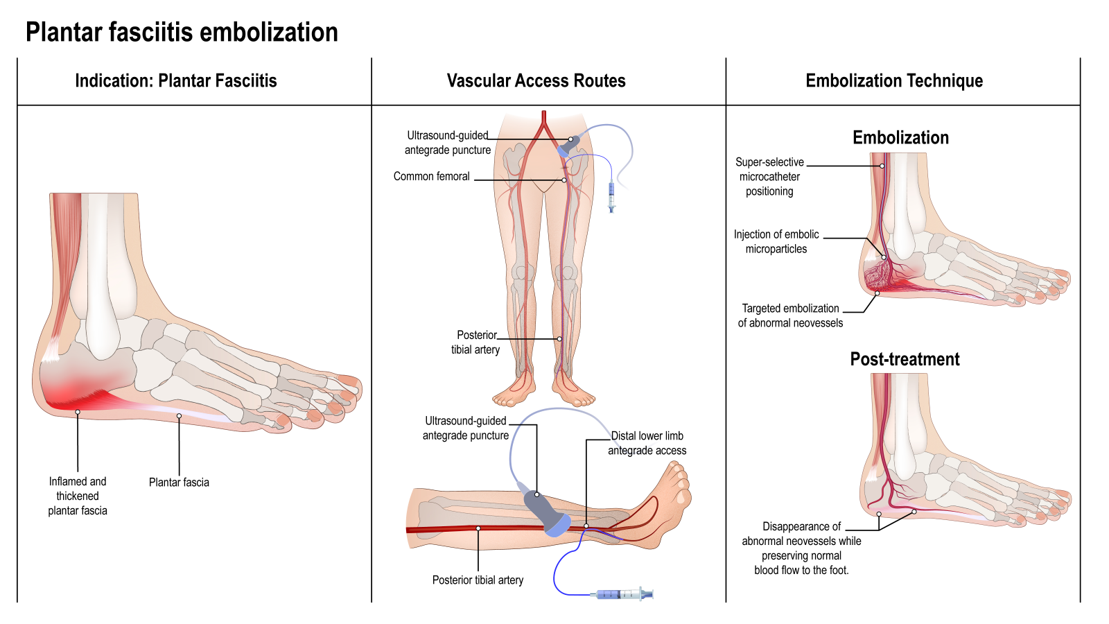 Illustration of embolisation for plantar fasciitis: the inflamed and thickened plantar fascia, access through the artery at the top of the thigh or in the lower leg, and the abnormal vessels being blocked
