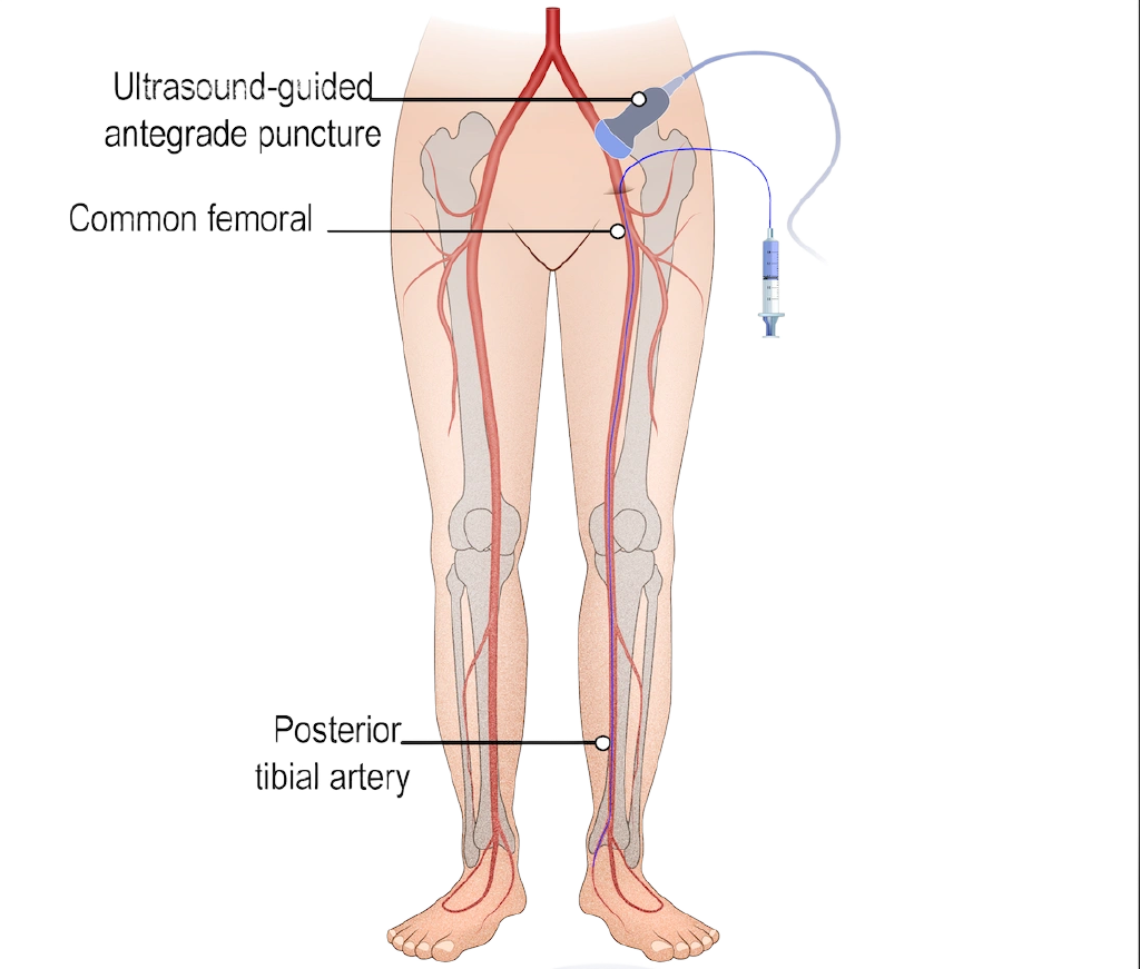 Access through the artery at the top of the thigh