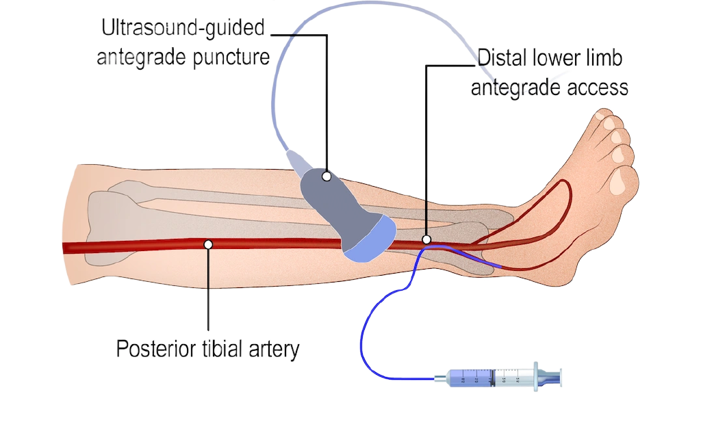 Access through an artery in the lower leg