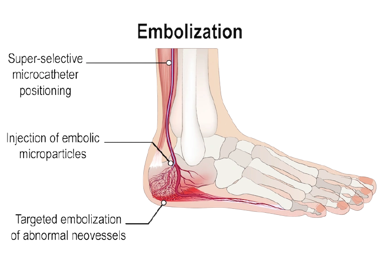 Tiny particles are injected into the abnormal vessels in the heel