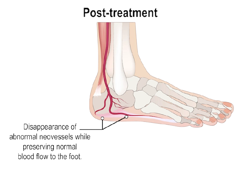 After treatment: abnormal vessels gone and normal blood flow to the foot kept