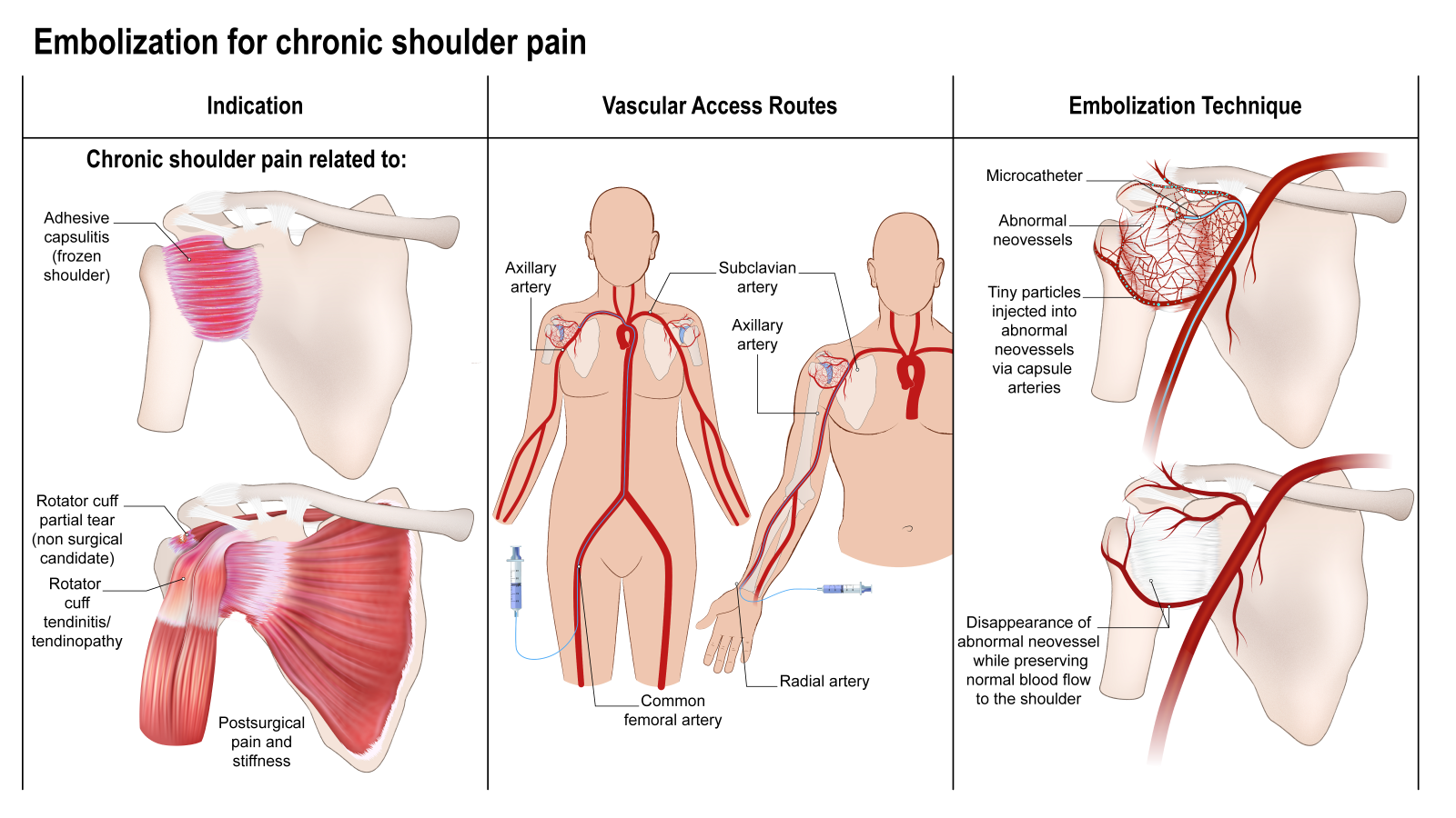 Illustration of embolisation for chronic shoulder pain: the conditions treated, the access routes through the groin or wrist, and how the abnormal vessels are blocked