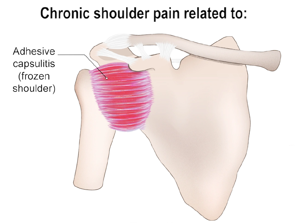Frozen shoulder: the inflamed joint capsule