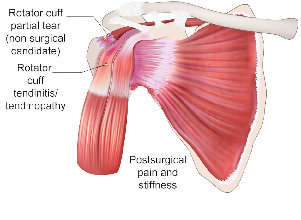 Rotator cuff tendinopathy and partial tear and stiffness after surgery