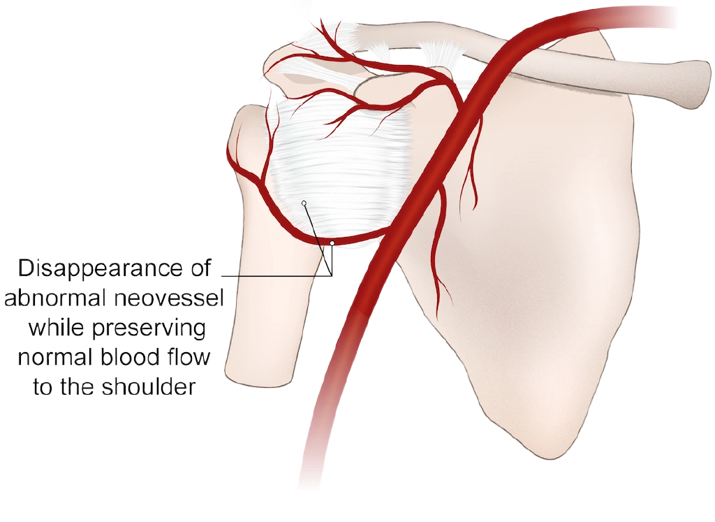 After treatment: abnormal vessels gone and normal blood flow kept