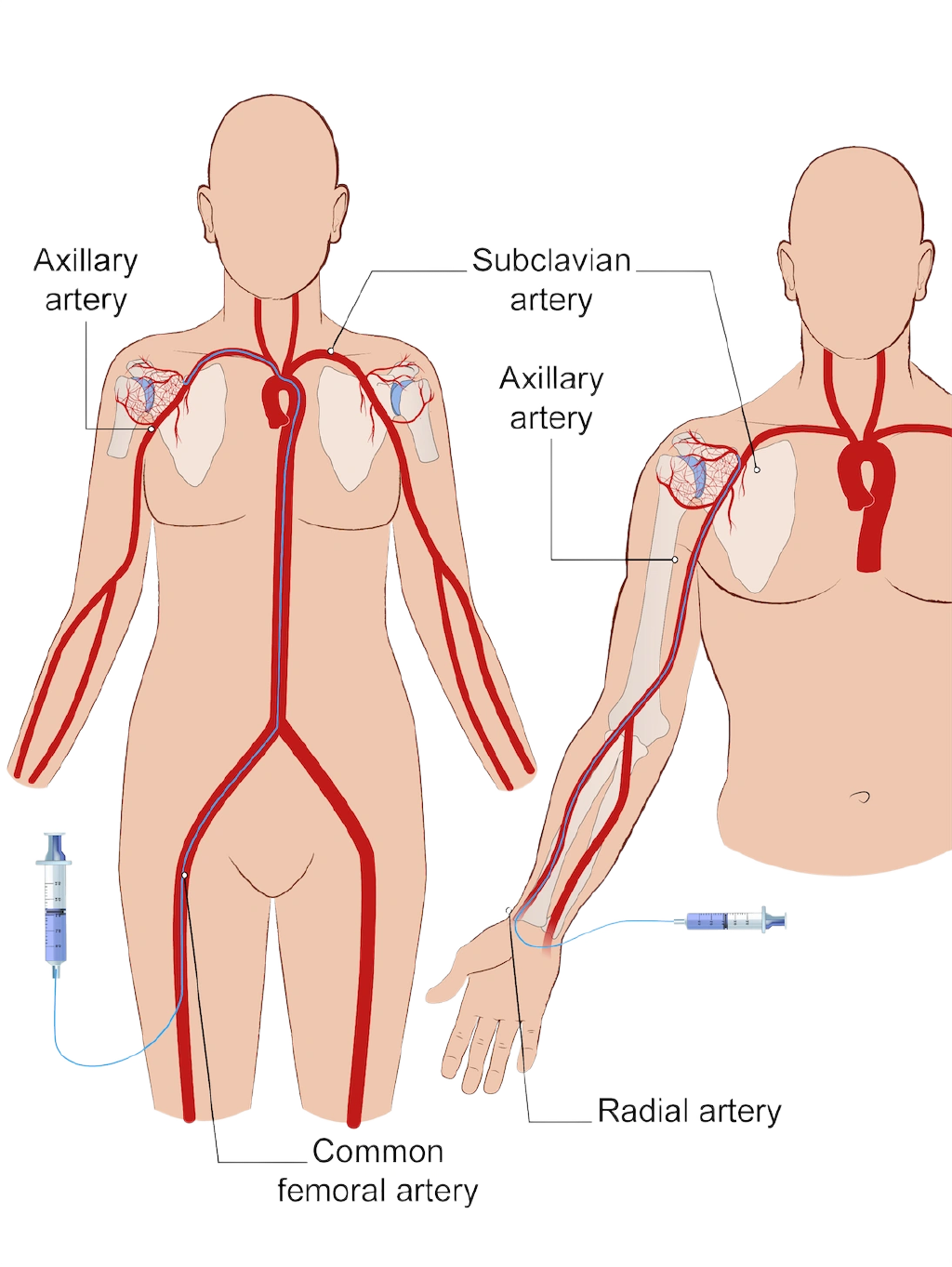 Access through the artery at the top of the thigh or at the wrist