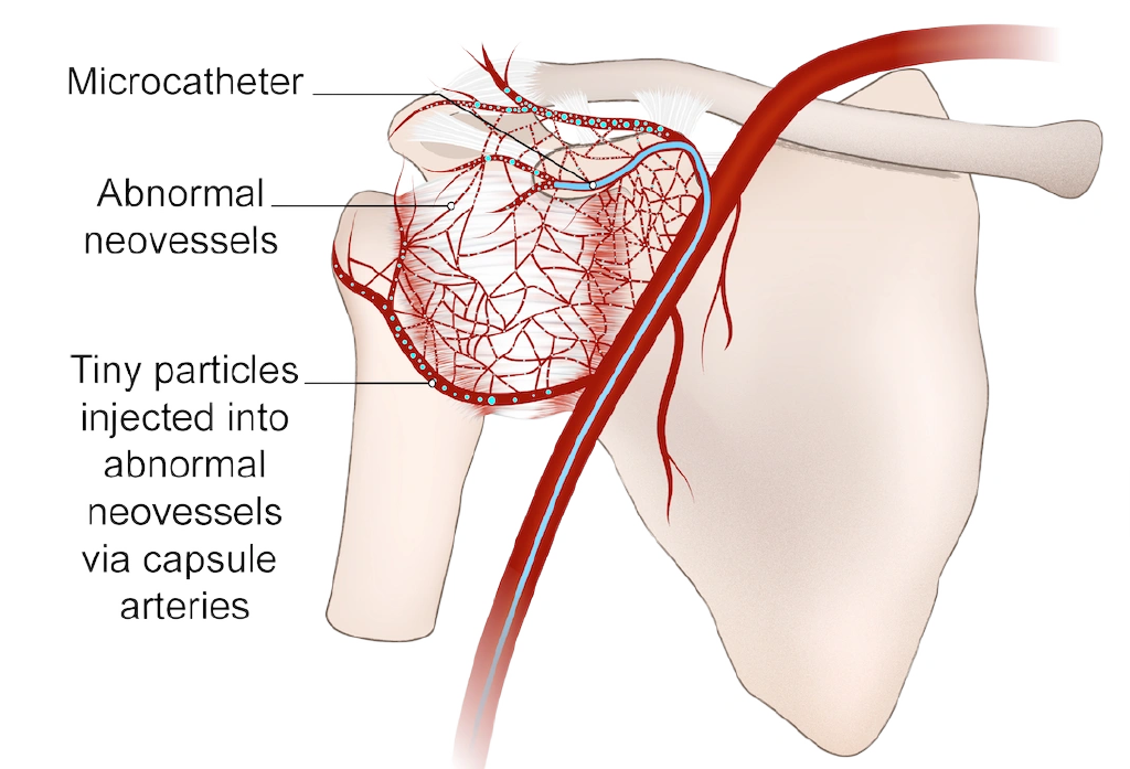 A fine catheter delivers tiny particles into the abnormal vessels