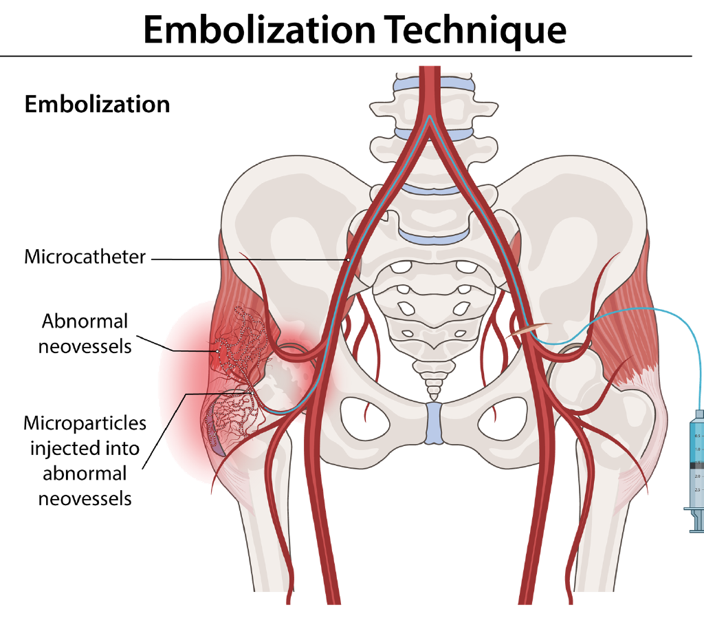 Illustration of hip embolization technique