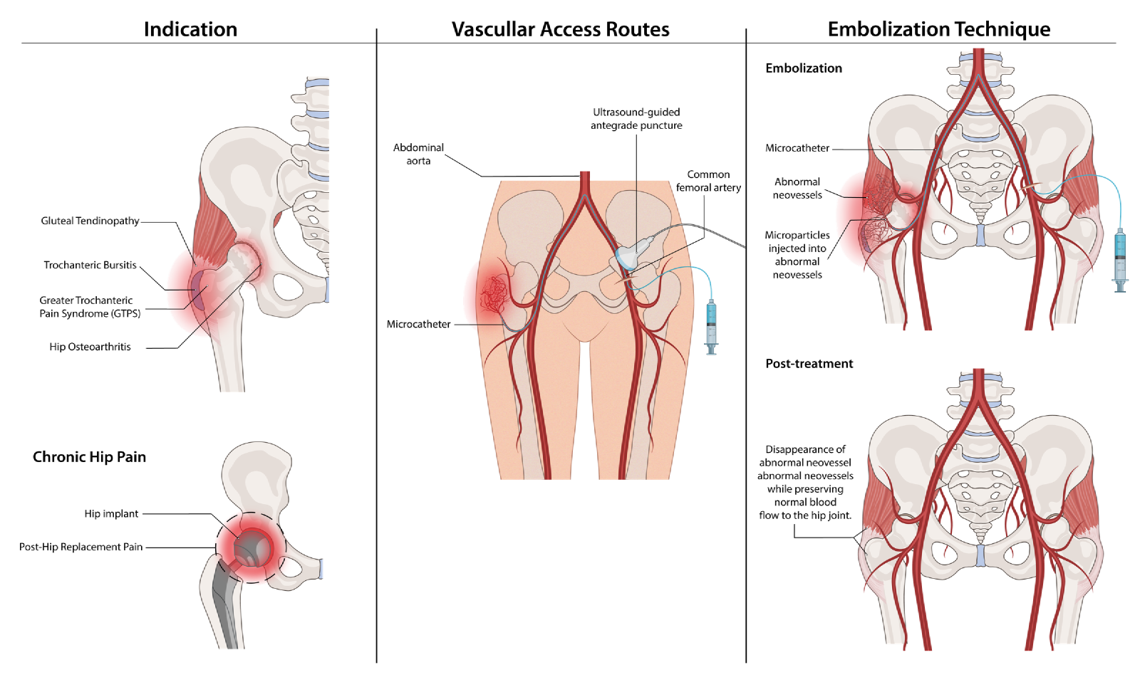Illustration of hip embolization for chronic hip pain