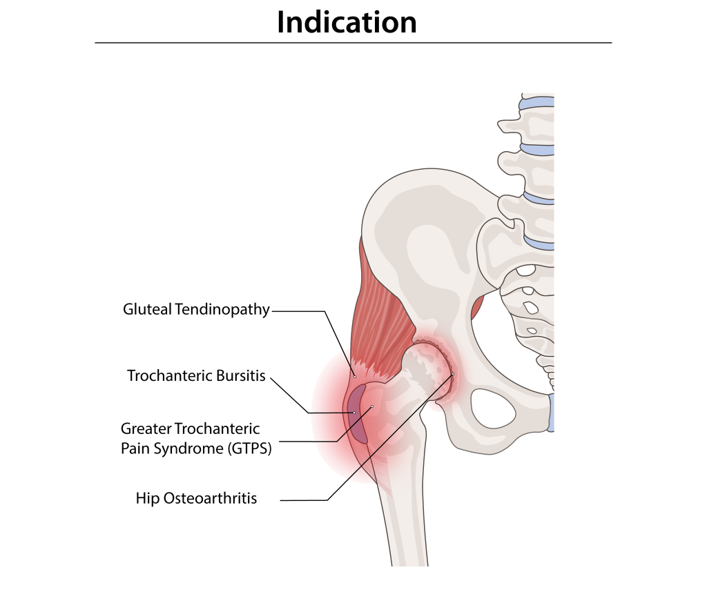 Illustration of GTPS and hip osteoarthritis
