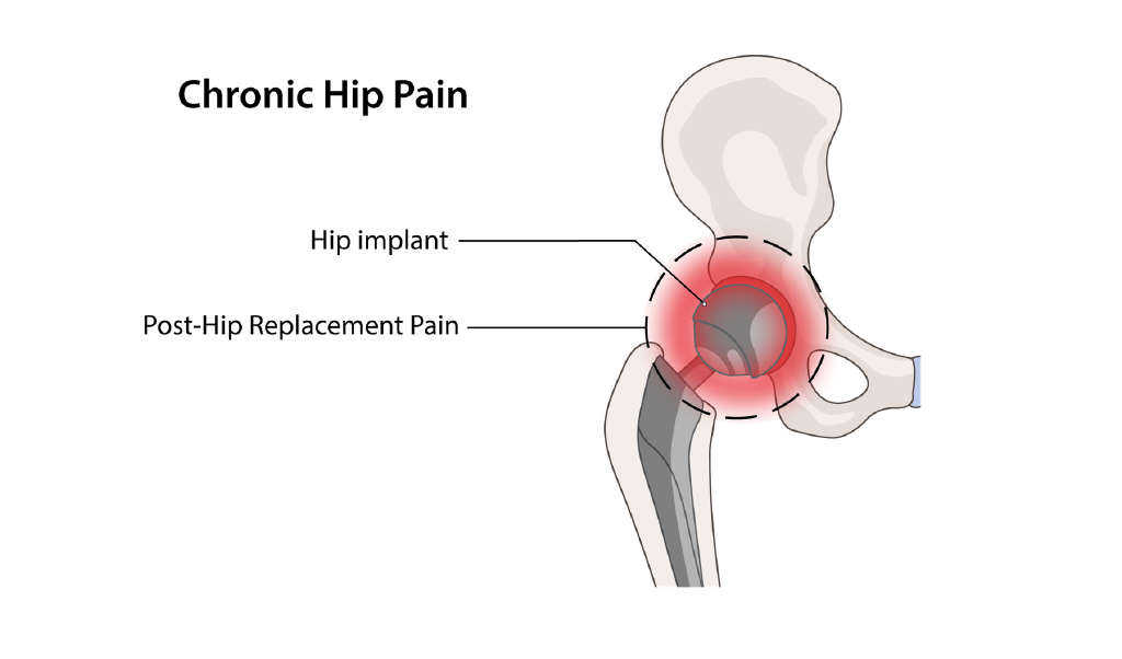 Illustration of post-hip replacement pain