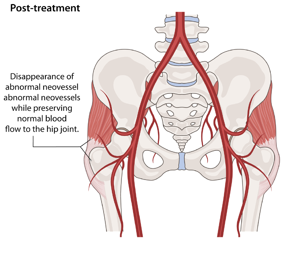 Illustration of post-treatment blood flow after hip embolization