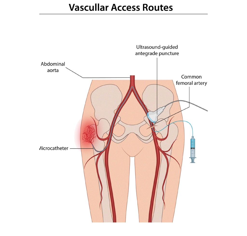Illustration of vascular access routes for hip embolization