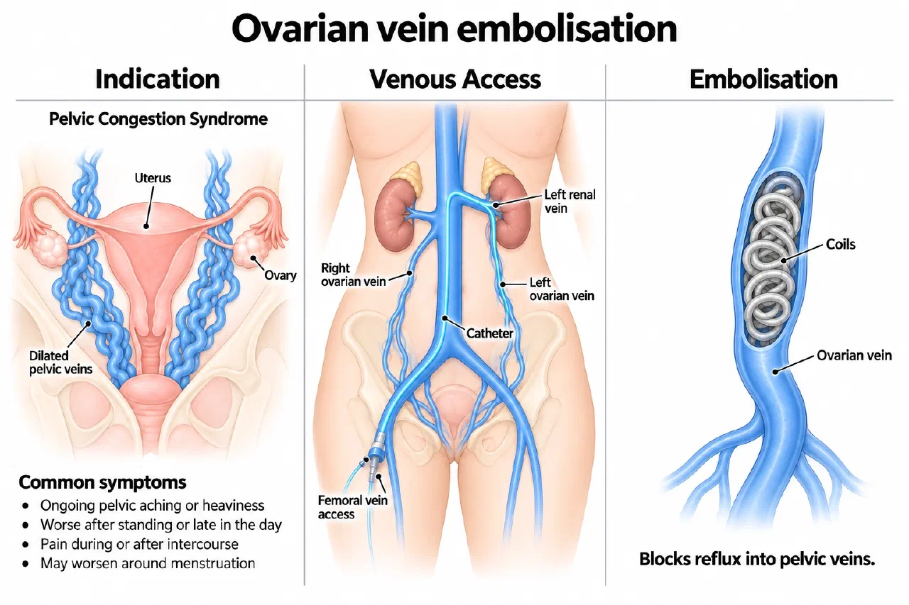 Illustration of ovarian vein embolisation for pelvic congestion syndrome: dilated pelvic veins, femoral vein access to the ovarian vein, and coils blocking reflux (AI-generated illustration)