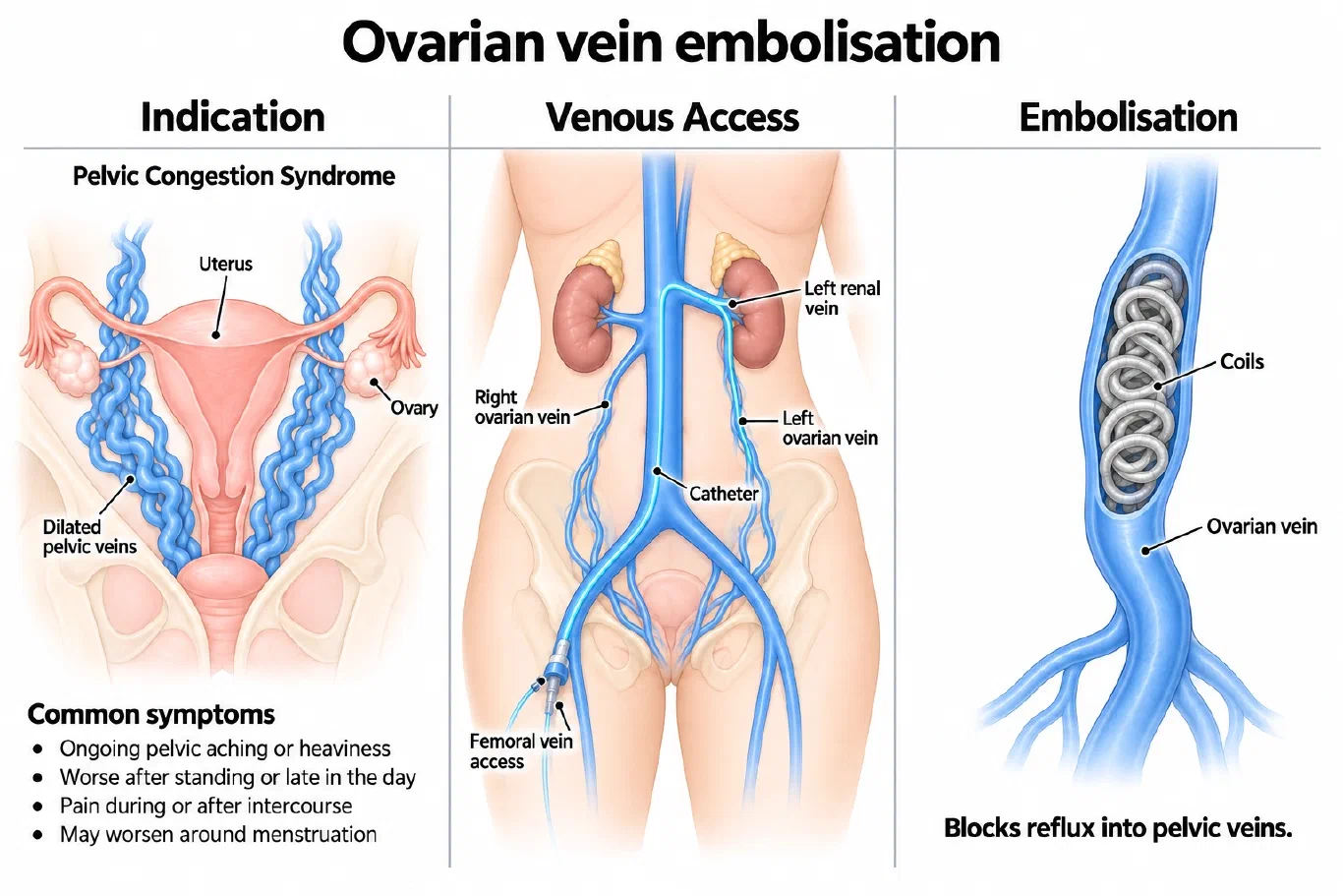 Illustration of ovarian vein embolisation for pelvic congestion syndrome: dilated pelvic veins, femoral vein access to the ovarian vein, and coils blocking reflux (AI-generated illustration)